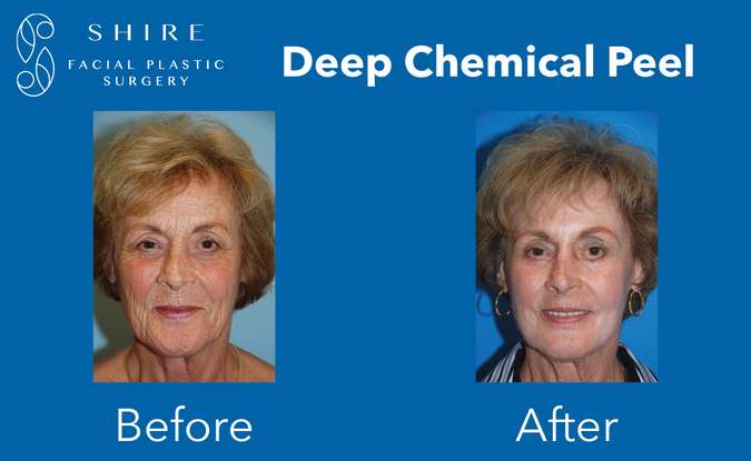 Deep Chemical Peel