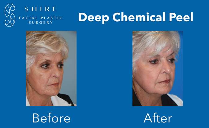 Deep Chemical Peel