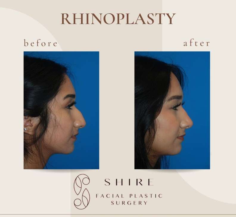 Rhinoplasty