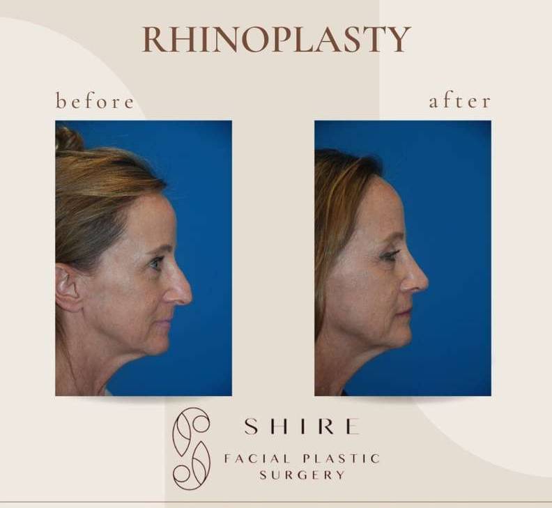 Rhinoplasty